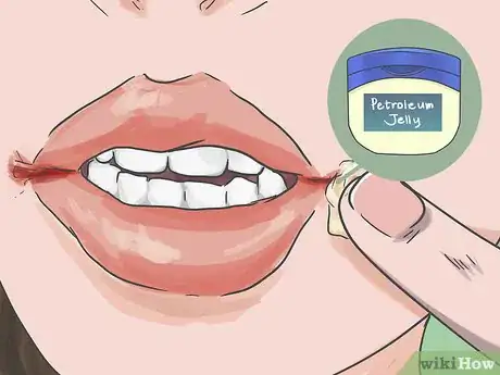 Image intitulée Heal Cracks in the Corners of Your Mouth Step 1