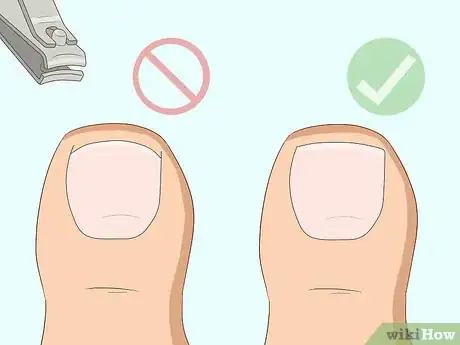 Image intitulée Relieve Ingrown Toe Nail Pain Step 27
