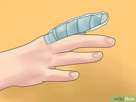 Image intitulée Splint a Finger Step 19
