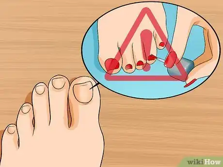 Image intitulée Get Rid of Yellow Toenails Step 1