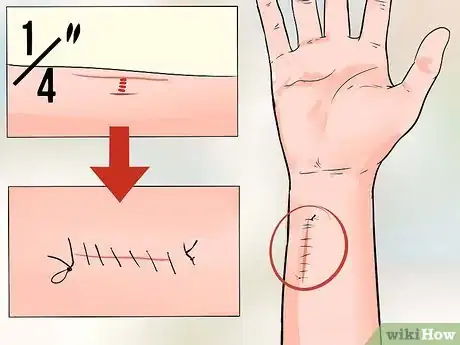 Image intitulée Determine if a Cut Needs Stitches Step 6