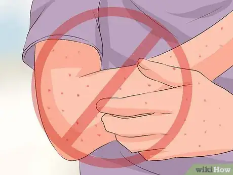 Image intitulée Recognize Chickenpox Step 11