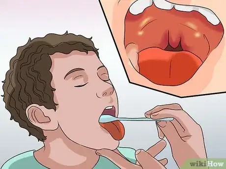 Image intitulée Diagnose Tonsillitis Step 3