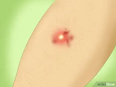 Comment traiter une infection à staphylocoques - wikiHow
