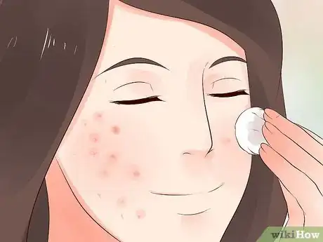 Image intitulée Get Rid of Acne Redness Step 1