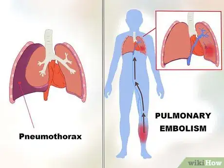 Image intitulée Ease Sudden Chest Pain Step 14