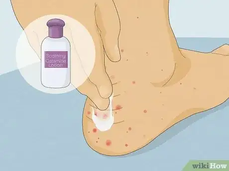 Image intitulée Treat Sand Flea Bites Step 1