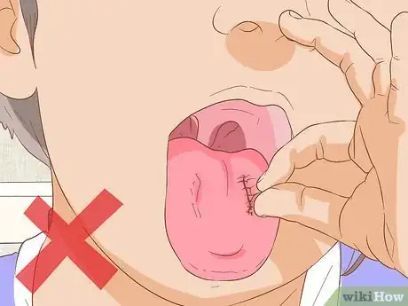 Image intitulée Stop Tongue Bleeding Step 15