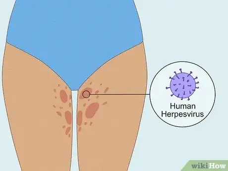 Image intitulée Get Rid of a Rash Between Your Legs Step 10