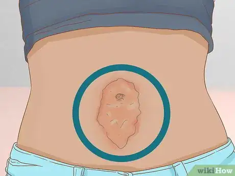 Image intitulée Clean Your Belly Button Step 6