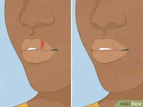 Image intitulée Treat a Cut Lip Step 11