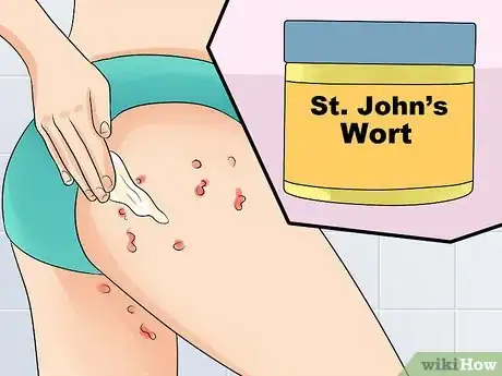 Image intitulée Ease Herpes Pain with Home Remedies Step 16