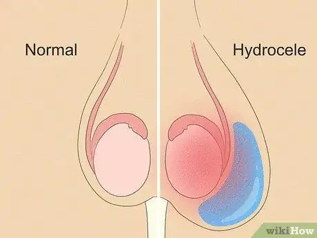 Image intitulée Cure a Hydrocele Step 1