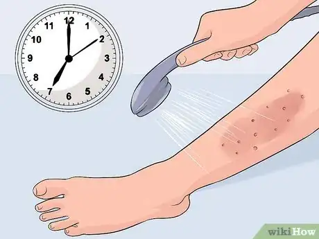 Image intitulée Get Rid of a Rash from Nair Step 2