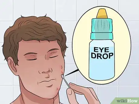 Image intitulée Decrease the Size of a Pimple Overnight Step 4