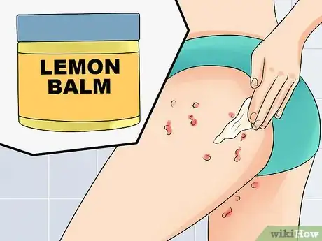 Image intitulée Ease Herpes Pain with Home Remedies Step 14