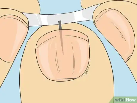 Image intitulée Remove a Splinter Under Your Fingernail Step 7
