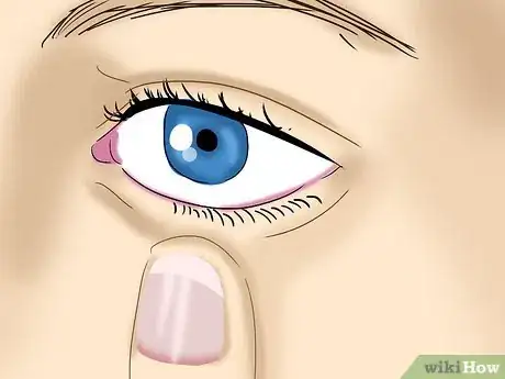 Image intitulée Take Out Contact Lenses Without Touching Your Eye Step 6