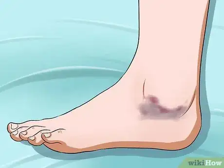 Image intitulée Soothe a Sore Ankle Step 2