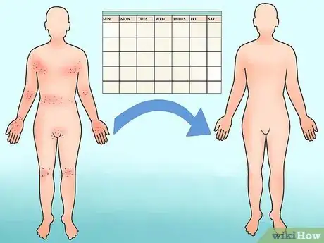 Image intitulée Recognize Scabies Rash Step 16