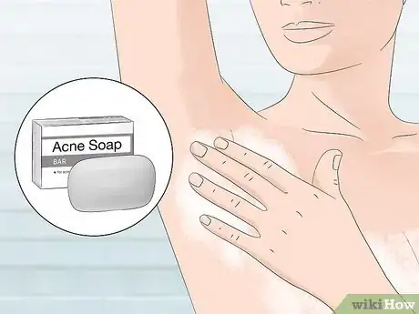 Image intitulée Stop Armpit Pimples Step 11