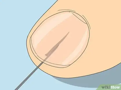 Image intitulée Remove a Splinter Under Your Fingernail Step 4