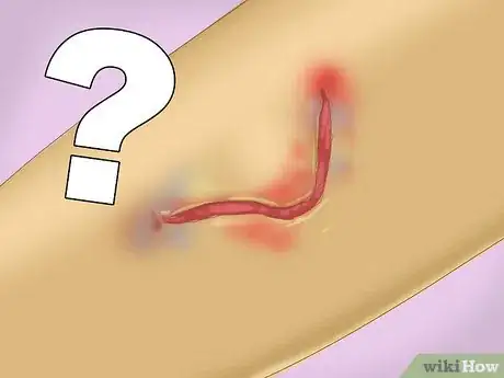 Image intitulée Treat a Skin Flap or Abrasion During First Aid Step 5