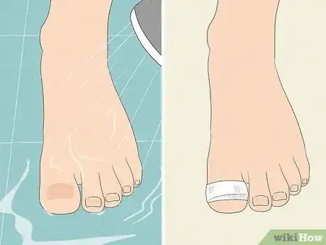 Image intitulée Remove a Dead Toenail Step 12