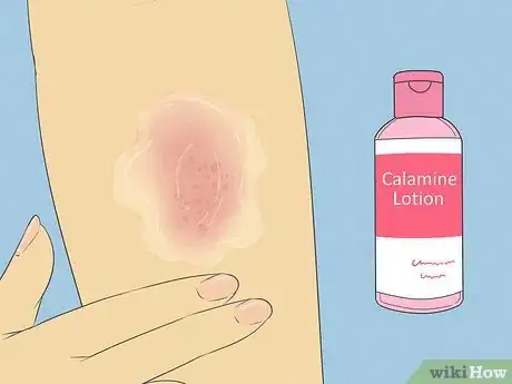 Image intitulée Get Rid of a Rash Step 9