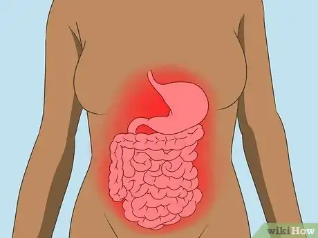 Image intitulée Treat Diverticulitis Step 10