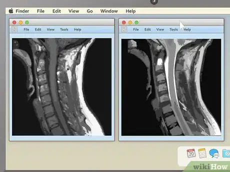 Image intitulée Read an MRI Step 7