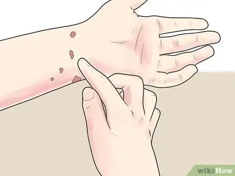 Image intitulée Kill Scabies At Home Step 17