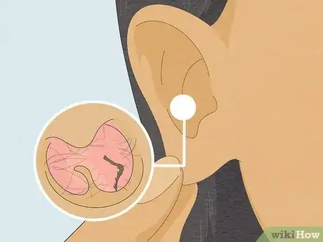 Image intitulée Remove a Bug from Your Ear Step 11