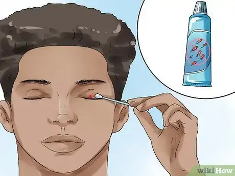 Image intitulée Get Rid of a Stye Step 4