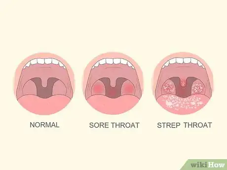 Image intitulée Tell if You Have Strep Throat Step 1