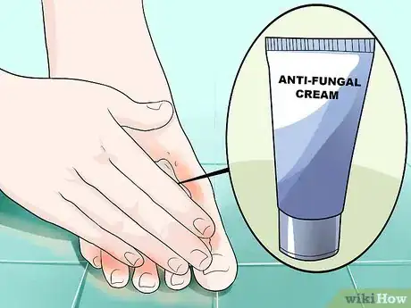 Image intitulée Get Rid of Foot Fungus Step 2