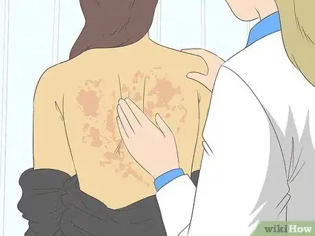 Image intitulée Get Rid of a Rash Step 13