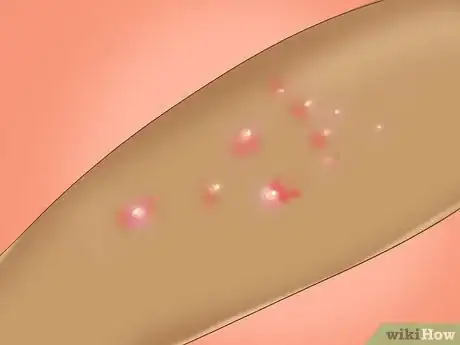 Image intitulée Recognize Molluscum (Molluscum Contagiosum) Step 2