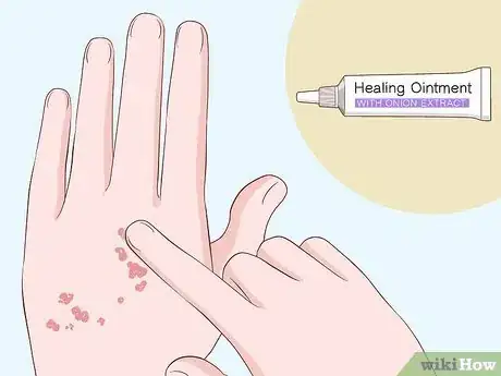Image intitulée Heal Scabies Scars Step 2