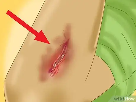 Image intitulée Treat a Skin Flap or Abrasion During First Aid Step 9