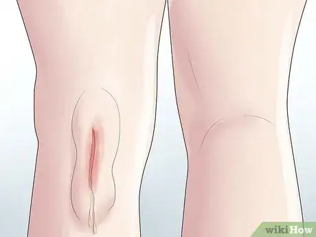 Image intitulée Know if You Have a Baker's Cyst Step 9