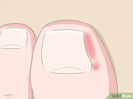 Image intitulée Relieve Ingrown Toe Nail Pain Step 3