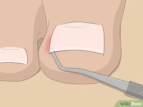 Image intitulée Relieve Ingrown Toe Nail Pain Step 15