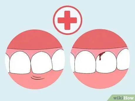 Image intitulée Heal a Bitten Tongue Step 4