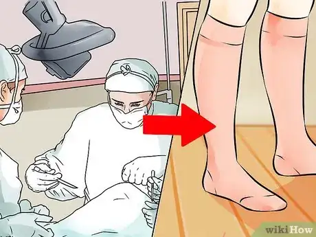 Image intitulée Put on Compression Stockings Step 23