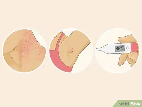 Image intitulée Treat Heat Rash Step 1