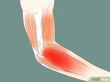 Image intitulée Heal a Sore Arm Step 1