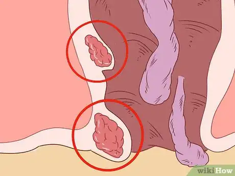 Image intitulée Care for Hemorrhoids Postpartum Step 27