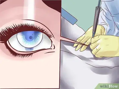 Image intitulée Lower Eye Pressure Without Drops Step 9