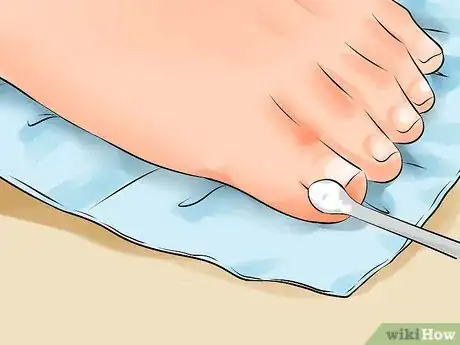 Image intitulée Remove an Ingrown Toenail Step 7